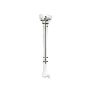 胫骨髓内钉