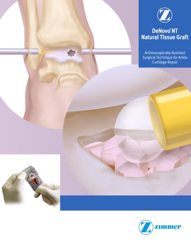 DeNovo&reg; NT Natural Tissue Graft Arthroscopically-Assisted Surgical Technique for Ankle Cartilage Repair